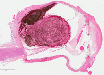 Figure 5: Ocular Melanoma: microscopic view from an enucleation procedure. (Courtesy of Dr. Rasmussen, Ophthalmologic Pathologist, Vancouver General Hospital).
